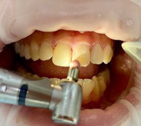 Полировка зубов