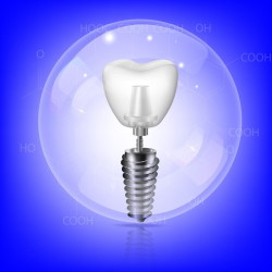 Зубной протез на имплантате